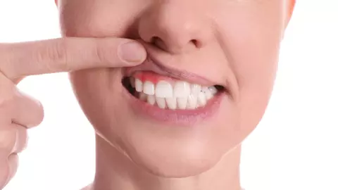 Află totul despre afecțiunile gingivale