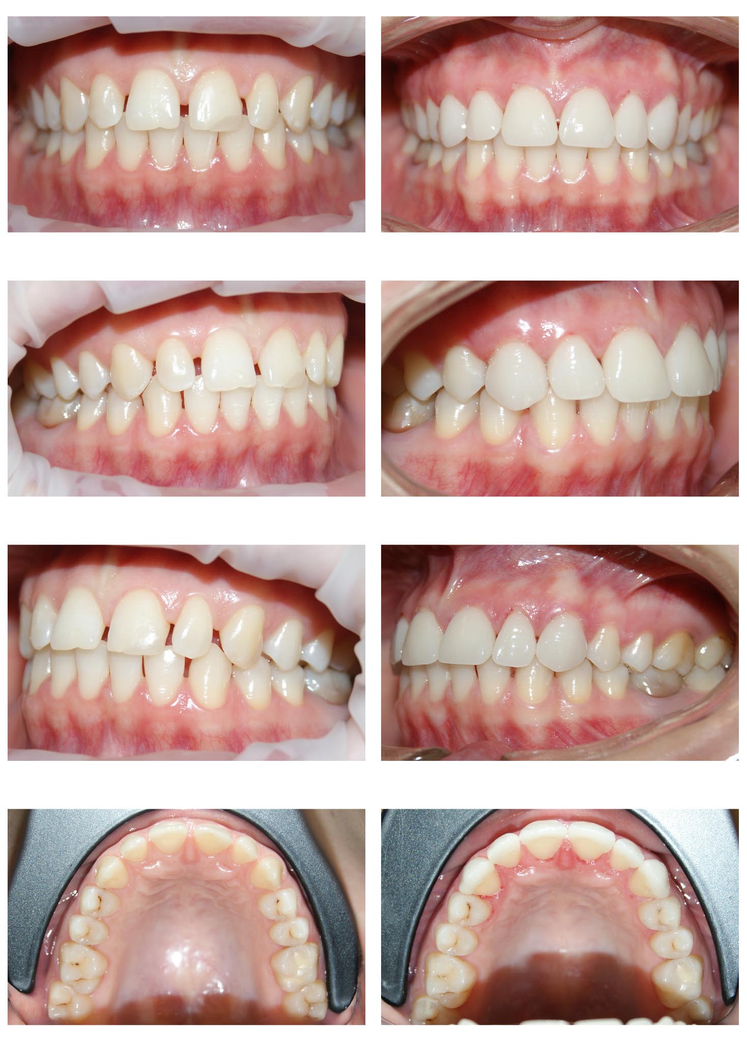 Caz de fațetare a dinților – o modalitate elegantă, estetică și mai ales minim invazivă de schimbare a formei și a dimensiunii dinților.