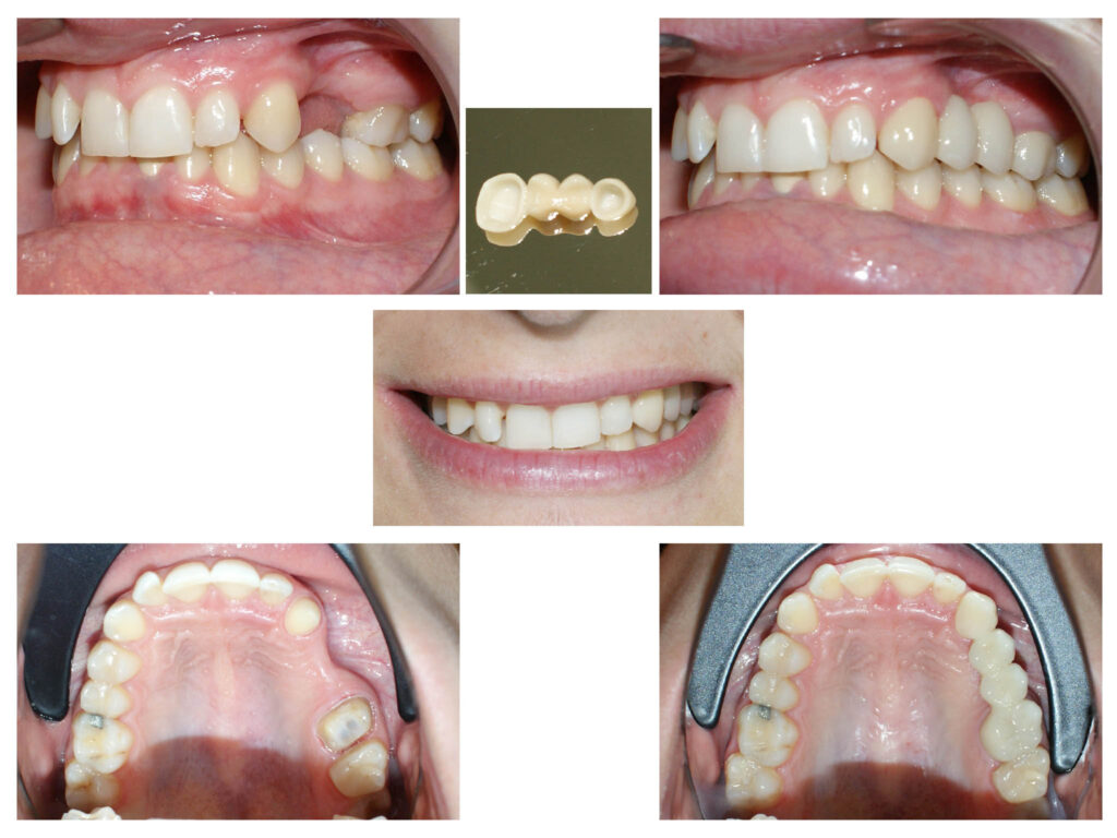 Lucrare protetică din Zirconiu stratificat- integrare estetică- praguri minim invazive pe dinți tineri, vitali – gingii sănătoase