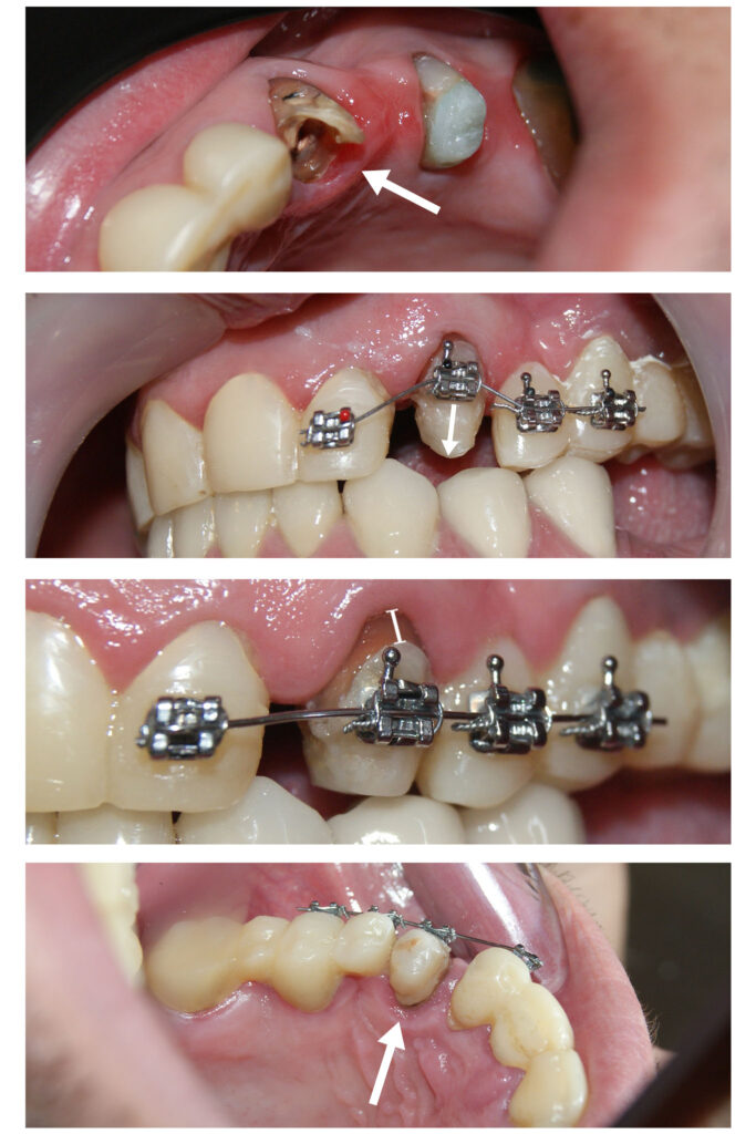 Extruzia ortodontică a dinților cu distrucție subgingivală accentuată salvează unii dinți de la extracție…pentru că dintele natural este cel mai bun implant. Săgețile evidențiază cât de multă extruzie am reușit să obținem în câteva luni.