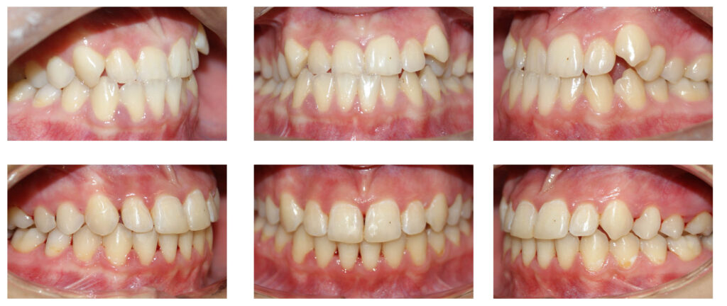 Crearea spațiului pentru alinierea dinților și pentru corectarea mușcăturii încrucișate.