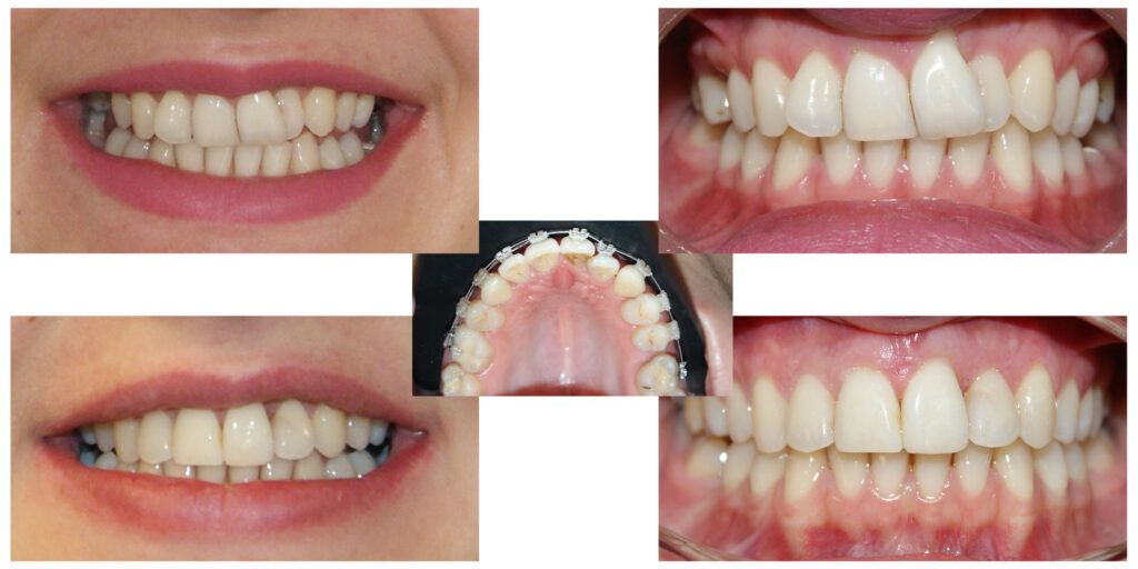 Îndreptarea axelor dentare are un efect semnificativ atât asupra dinților cât și asupra țesuturilor de susținere