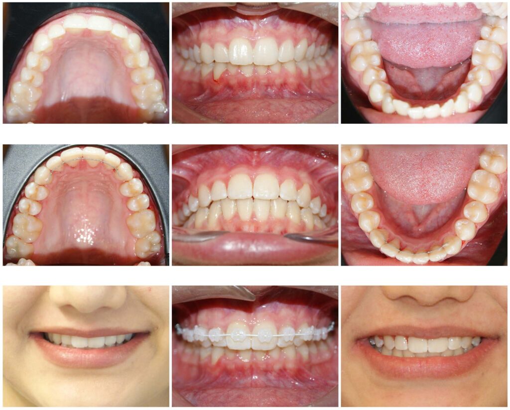 Pentru că detaliile fac diferența  – a se remarca înălțarea și lărgirea zâmbetului #contenție fixă