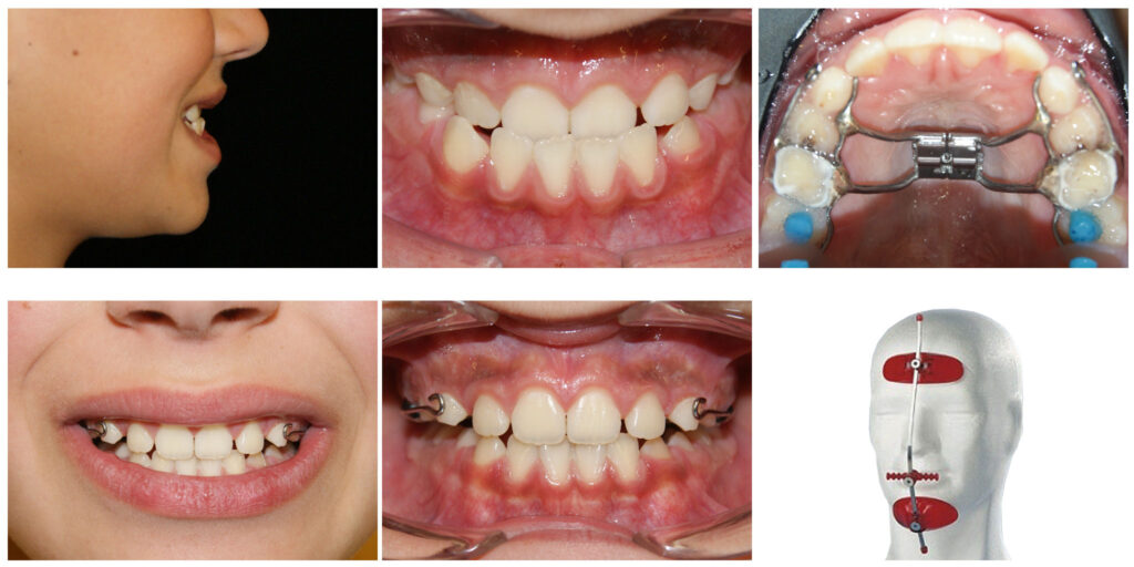 Corectarea muscaturii inverse cu forte extraorale – masca Delaire și disjunctor maxilar. Câteva luni pentru rezultate de care copilul se bucură întreaga viată