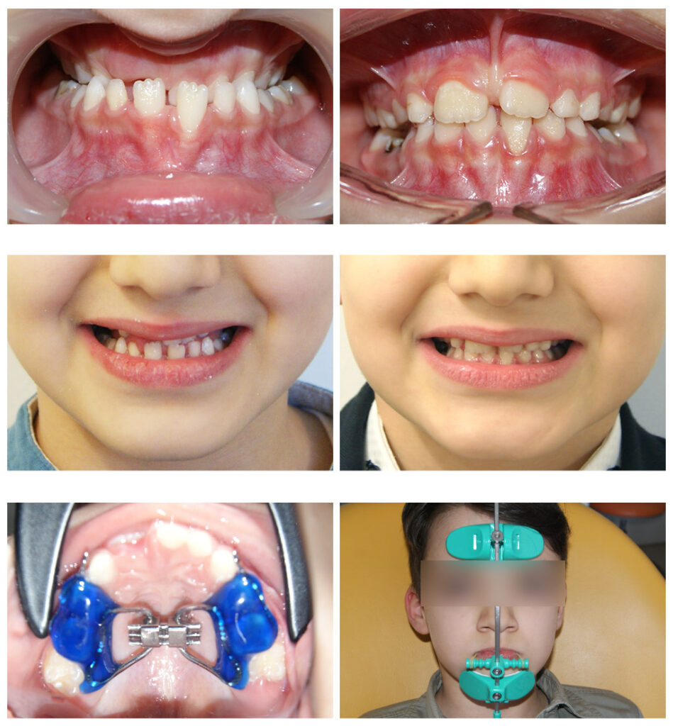 Corectarea muscaturii inverse cu forte extraorale – masca Delaire și disjunctor maxilar Alegem aparatul potrivit la vârsta potrivită