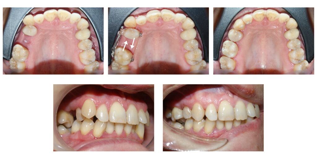 Am folosit într-un mod eficient și elegant spațiul postextracțional pentru a alinia dinții înghesuiți