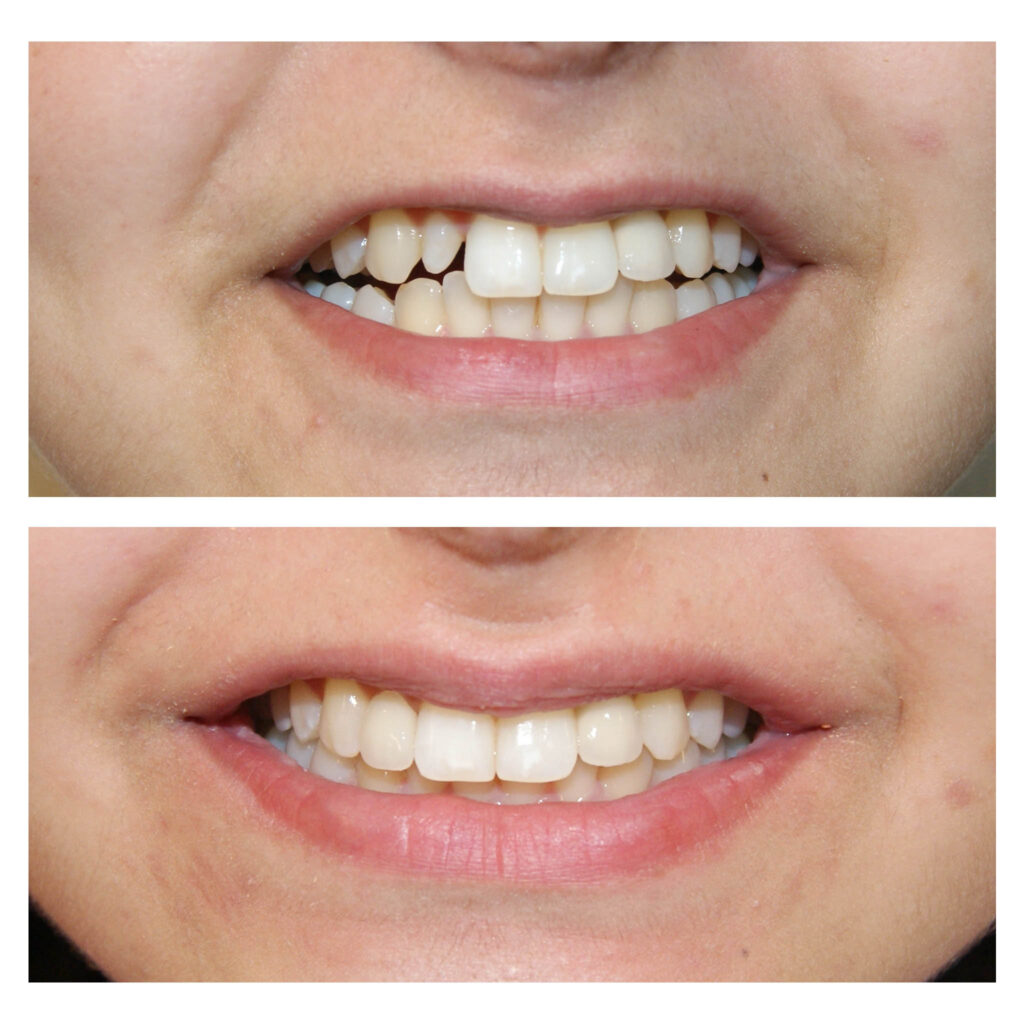 Dinții nanici își găsesc la noi rezolvare estetică și minim invazivă – coroniță cu preparare minimă ghidată