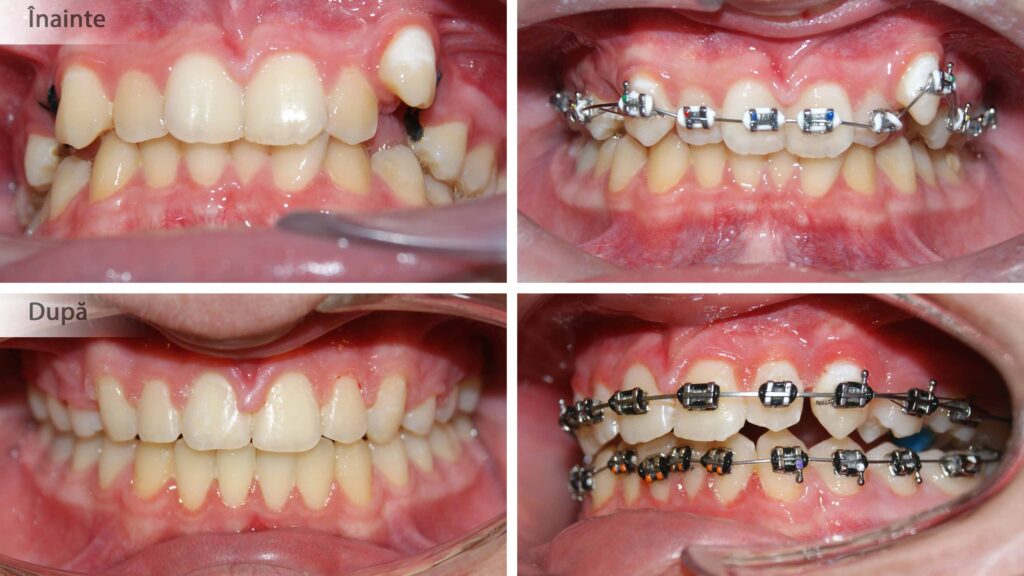 Caz cu extracție de 2 premolari pentru alinierea caninilor