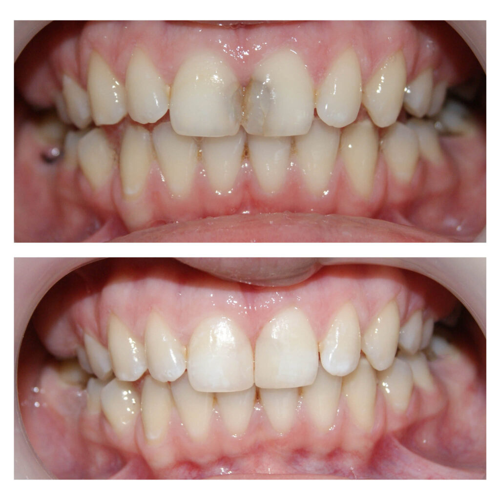 Înlocuirea plombițelor modificate de culoare devine un succes în mâinile noastre