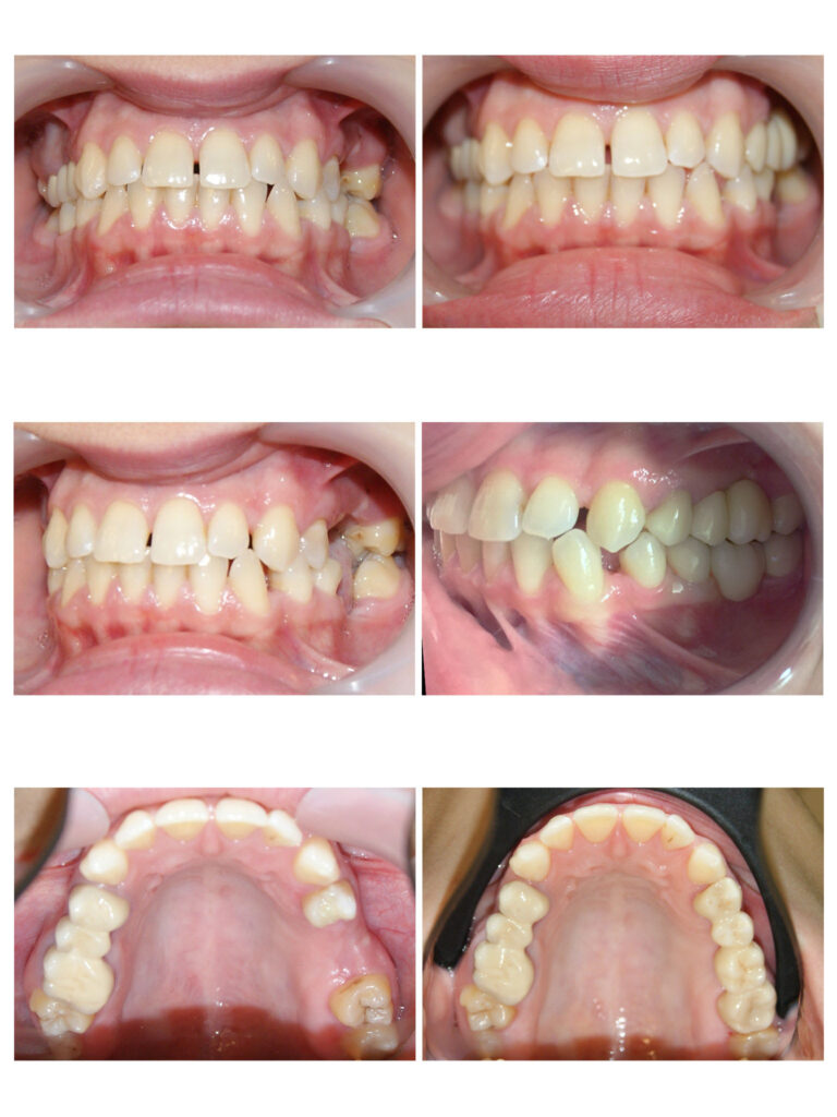 Lucrări protetice din zirconiu cu adaptare perfectă