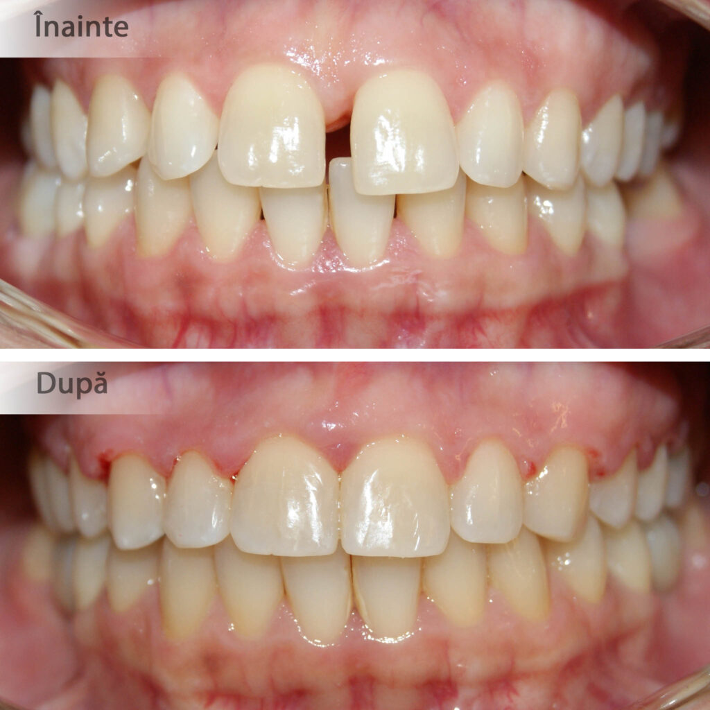 Adesea boala parodontală determină migrarea neplăcută a dinților. După încetinirea activității bacteriene dinții migrați pot fi readuși în poziție corectă