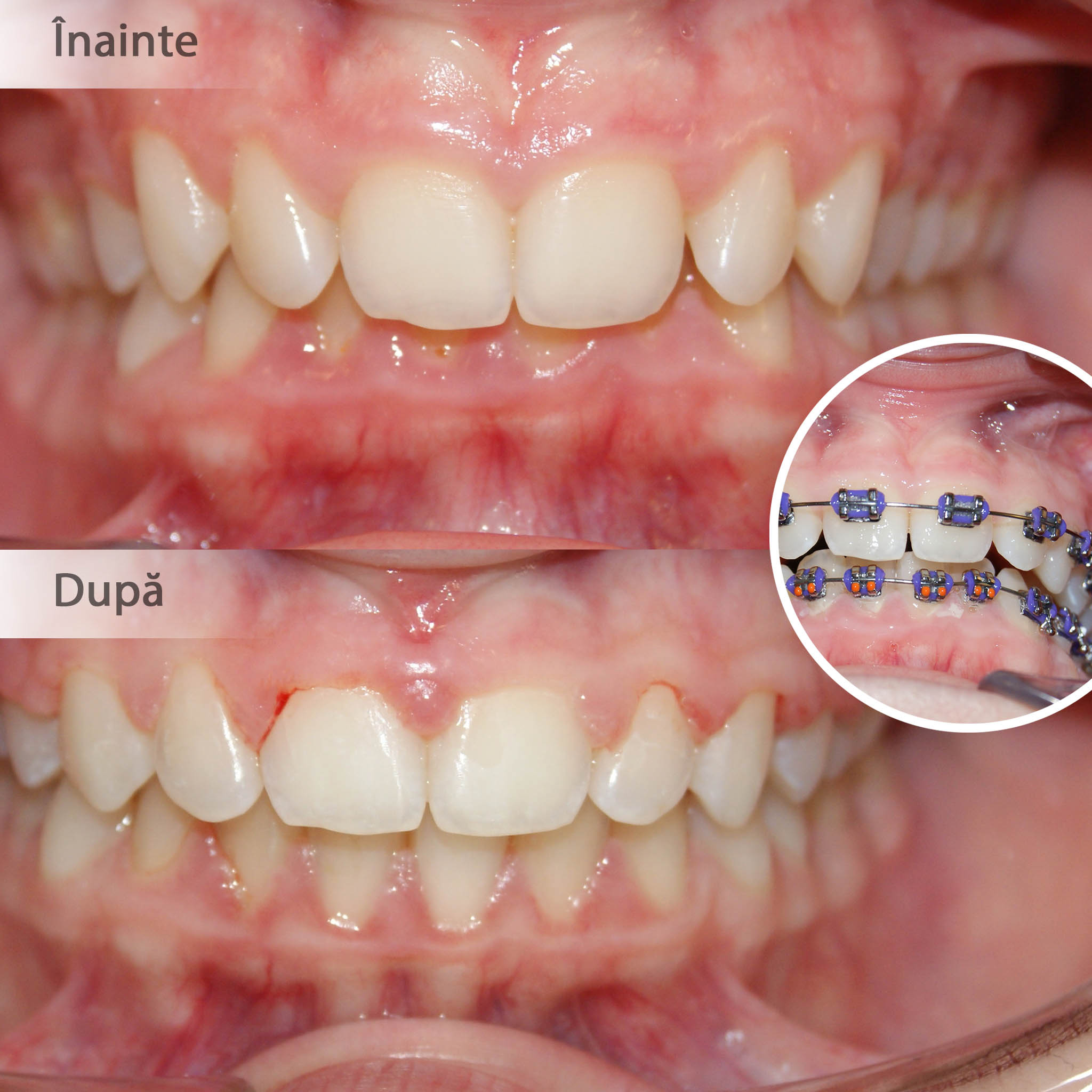Corectarea angulațiilor dentare și a mușcăturii