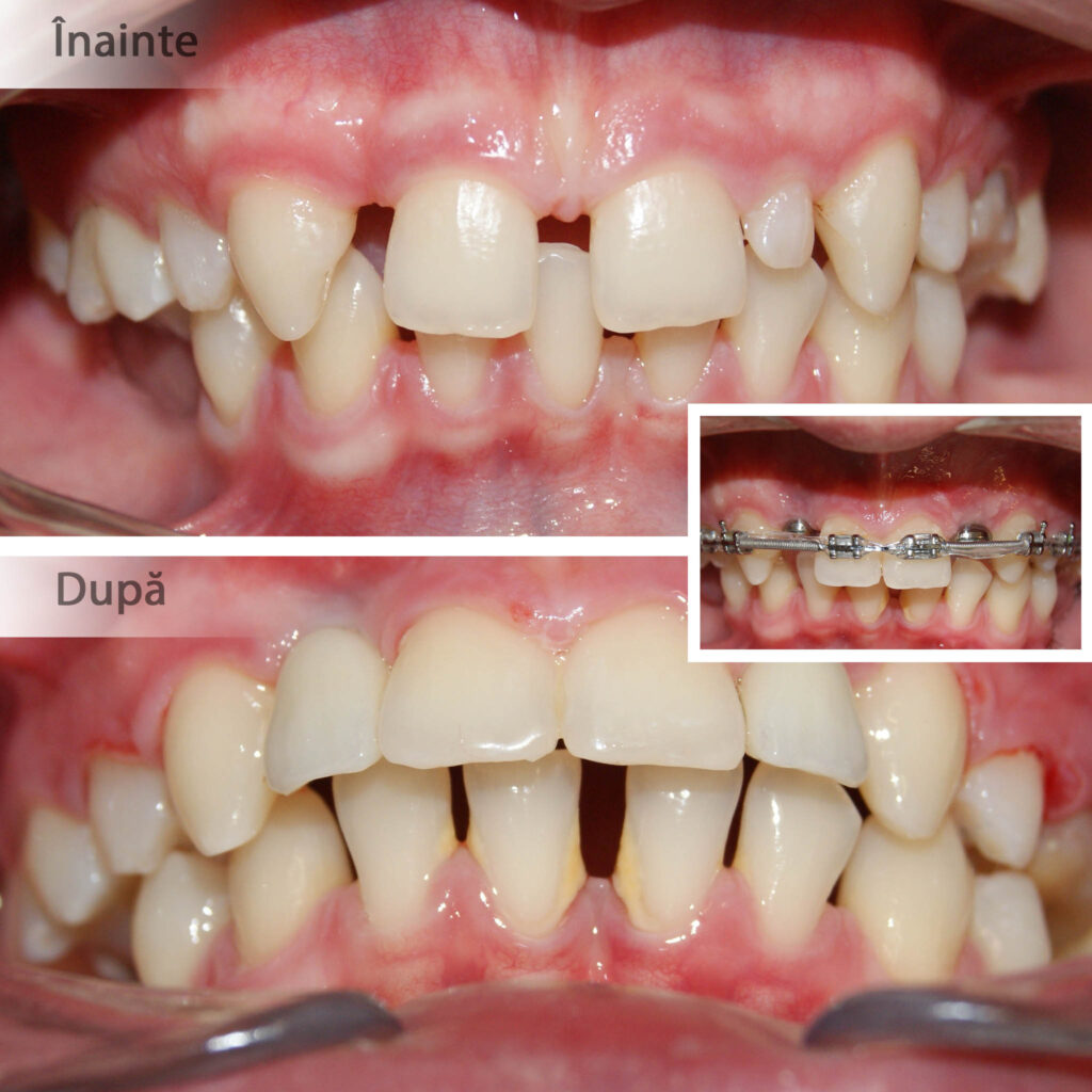 #anodonție #dinte nanic #aparat ortodontic #implante dentare