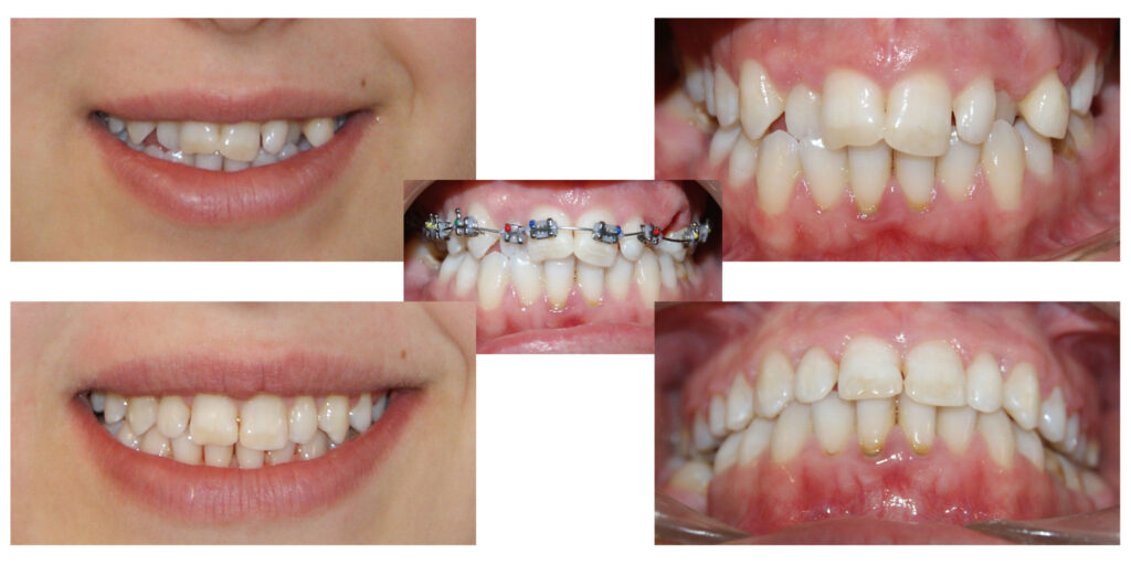 Persistența dinților de lapte peste timpul lor normal de exfoliere determină înghesuirea dinților definitivi. Aparatele dentare fixe sunt instrumentele perfecte pentru alinierea armonioasă a dinților