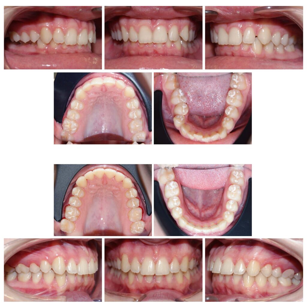 Pozițiile copiilor în somn (cu pumnul sub obraz) timp îndelungat poate determina dezvoltarea asimetrică a oaselor maxilare. Așa cum se vede în poze, cu ajutorul aparatelor ortodontice fixe am îndreptat axele dentare