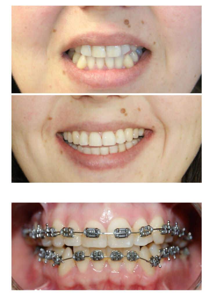 În cazul de față ortodonția ne-a ajutat să oferim lărgime semnificativă zâmbetului și să prevenim retracțiile gingivale de pe caninii inferiori prin distalizare.