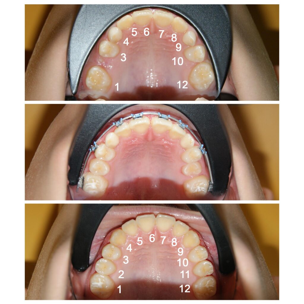 Recâștigarea spațiilor pierdute pentru dinții numerotați cu 2 si 11. Dacă nu am fi pus aparatul ortodontic fix dinții ar fi rămas blocați în intriorul osului, cu consecințe dramatice