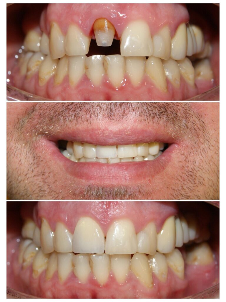 Coroniță zirconiu pe incisivul central cu integrarea estetică