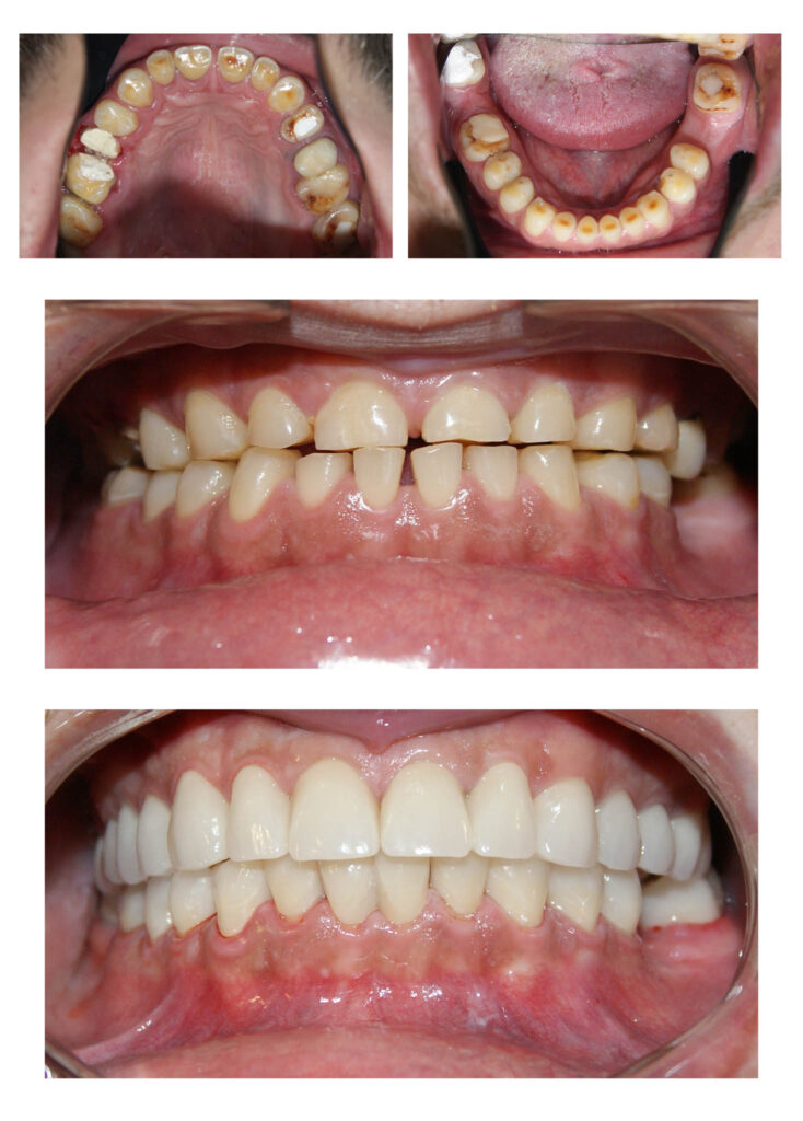 Reabilitare orală complexă cu redimensionarea dinților cu grad accentuat de uzură. A fost necesară o soluție de provizorat de 6 luni de zile în care am verificat dacă pacientul se poate adapta cu înălțarea ocluzală propusă de noi. Am realizat tratamente de canal și reconstituiri atât pentru înălțarea dinților, cât și pentru tratarea proceselor infecțioase active. Rezultatele sunt remarcabile atât din punct de vedere funcțional cât și estetic