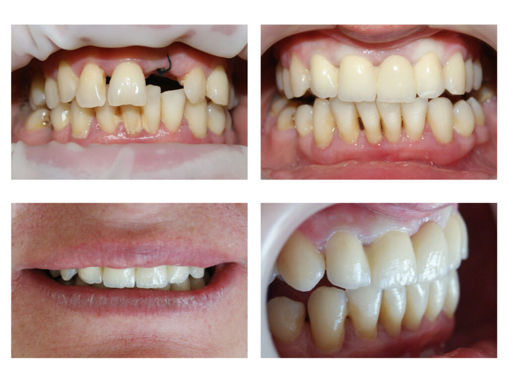 Protezarea fixă a incisivului central superior cu lucrarea din zirconiu stratificat
