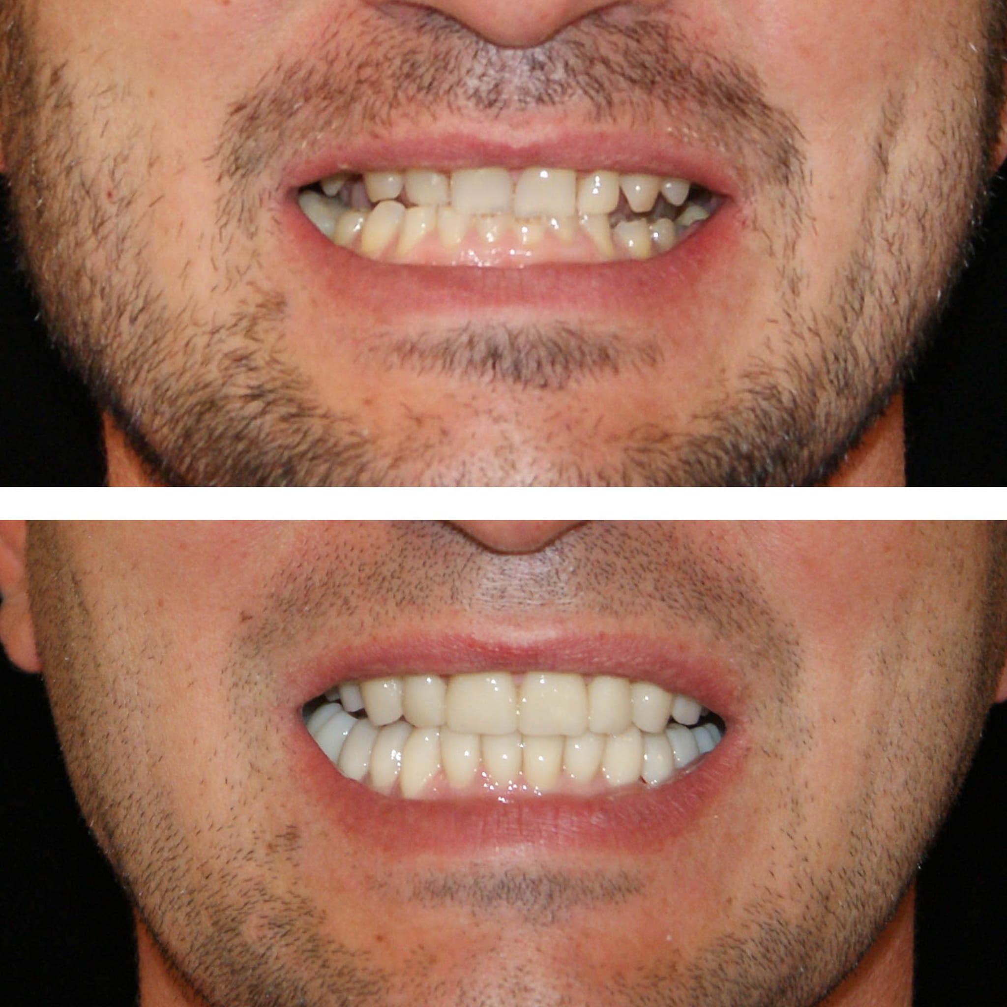 Reabilitare complexă și completă a dinților