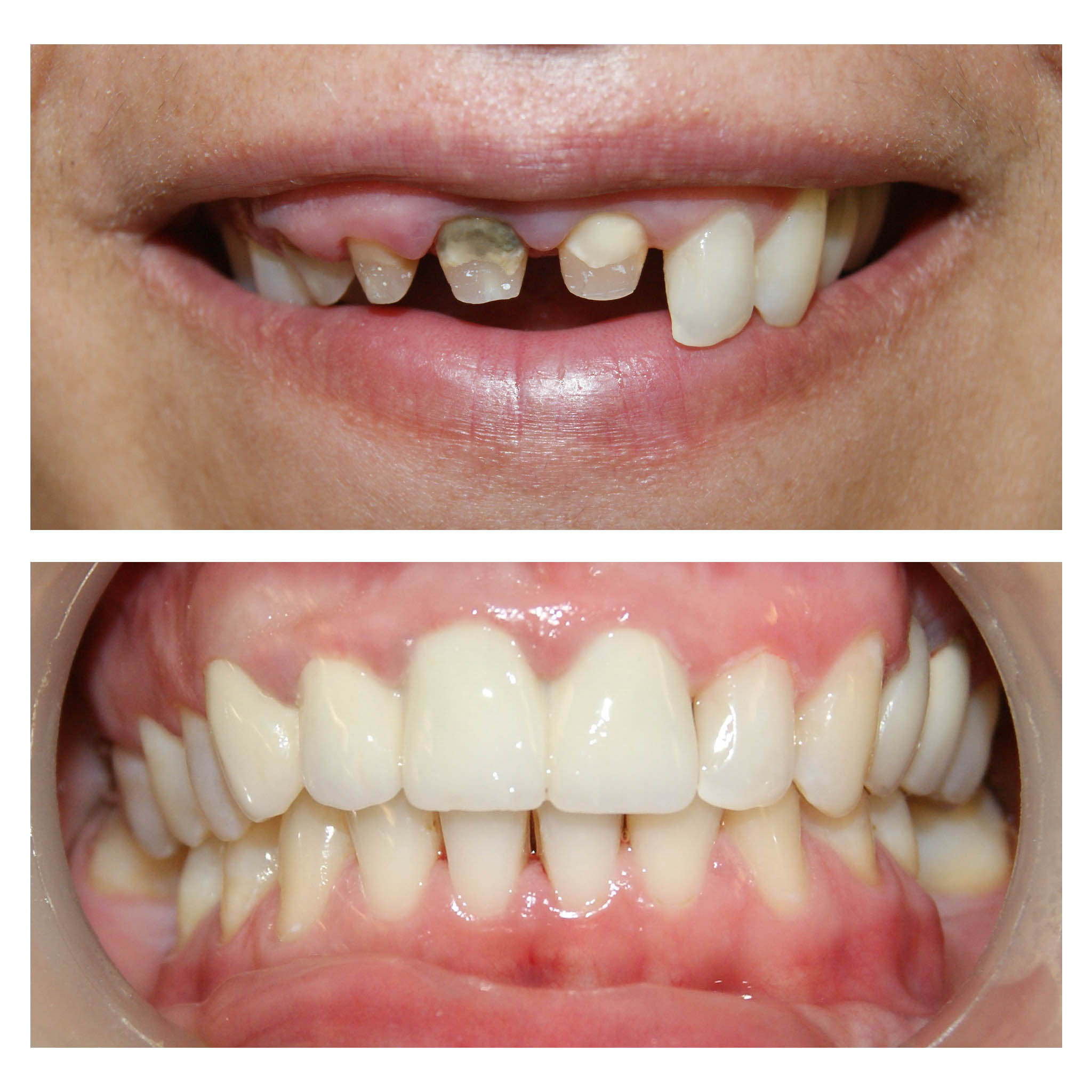 Zirconiu Stratificat