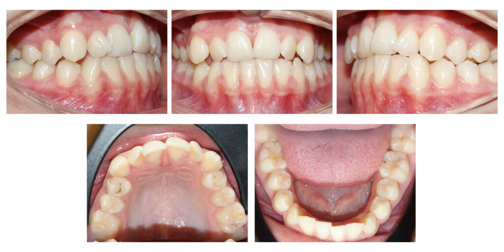 Ocluzie încrucișată | Ancoraj pe mini implante | Brackets | Simetrizarea conturului zâmbetului