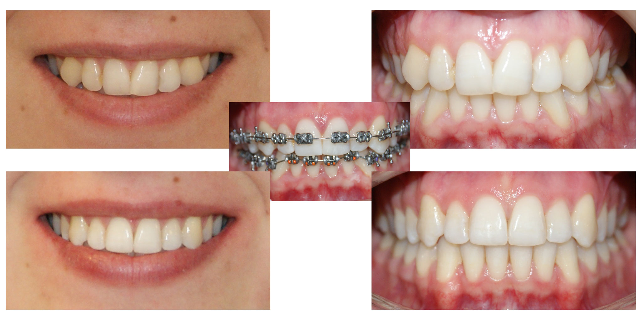 Brackets – Teeth Detailing